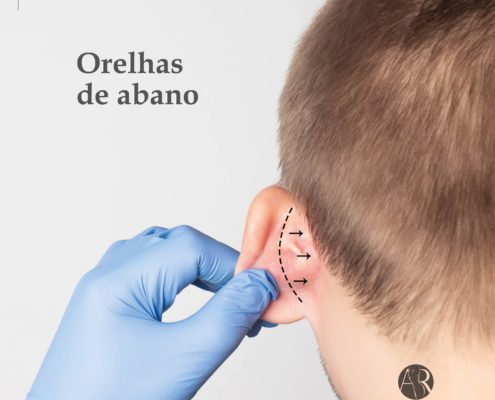 Orelhas de abano